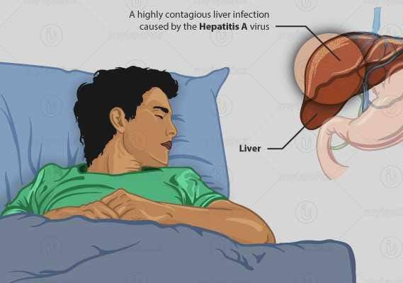 हेपेटाइटिस ए hepatitis A