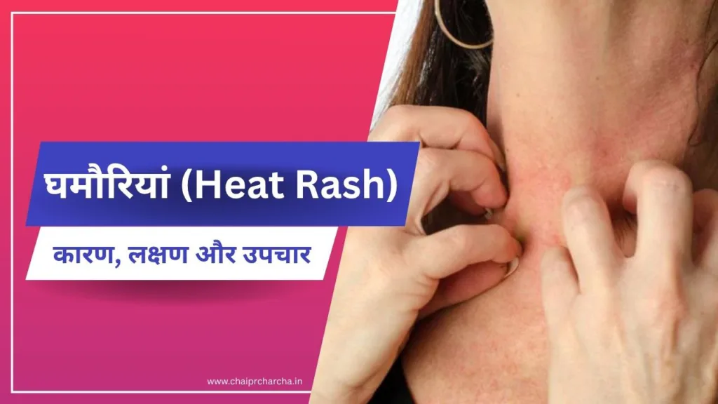 घमौरियां (Heat Rash): कारण, लक्षण और उपचार